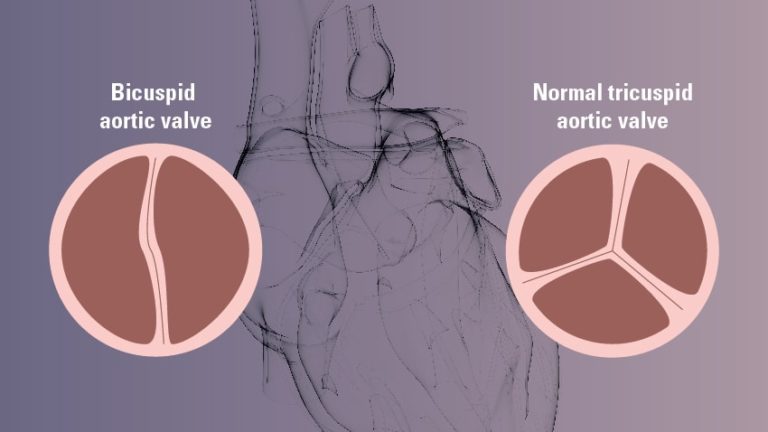 what-is-a-bicuspid-aortic-valve-cardiovascular-interventions-orlando