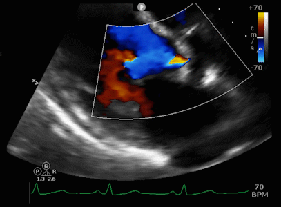 echocardiogram heart ultrasound vs