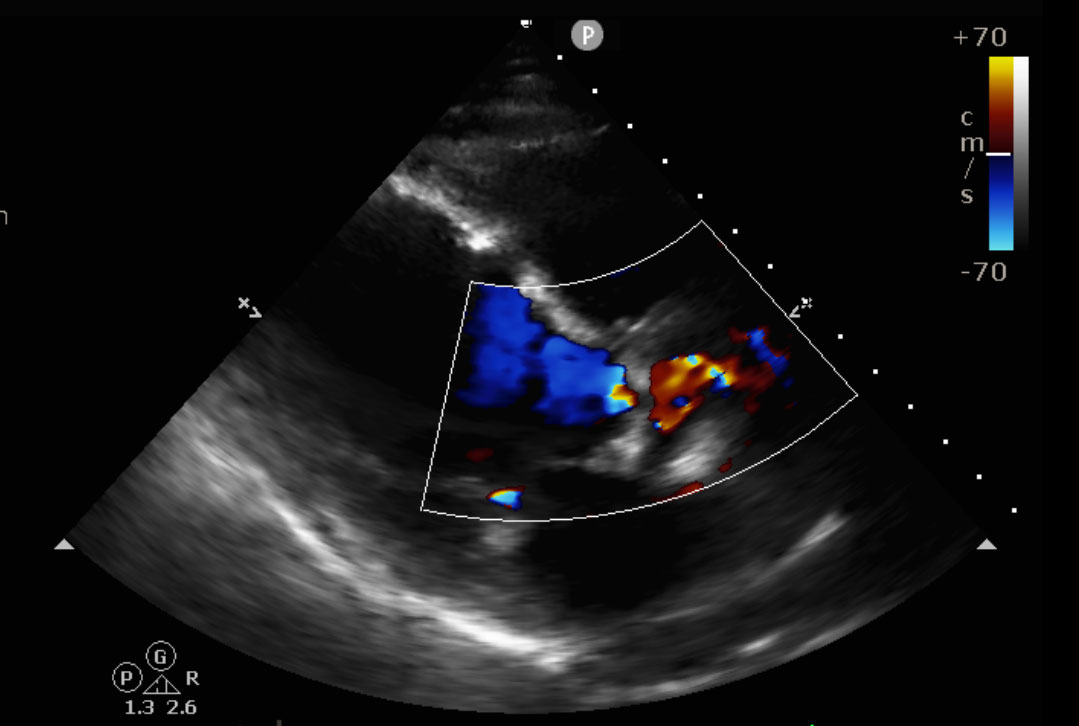 How To Say Transesophageal Echocardiogram