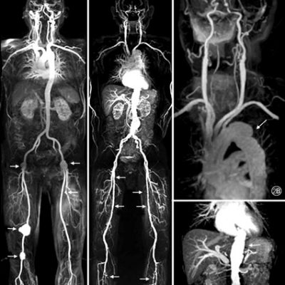 Abdominal Aortic Aneurysms (AAA) - Cardiovascular Interventions Orlando