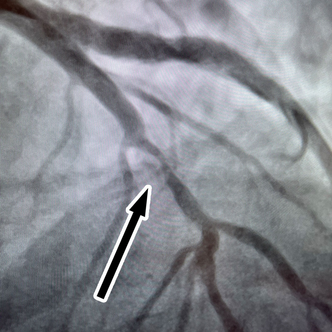 Intravascular Lithotripsy Therapy - New Treatment For Advanced Heart ...