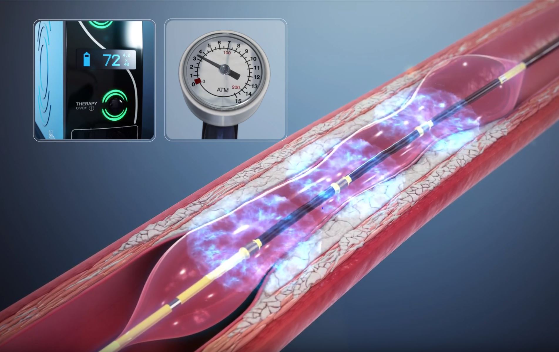 shockwave-intravascular-lithotripsy-system-cardiovascular